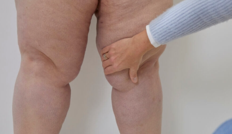 Diyete ve spora rağmen bacaklarınız, kollarınız veya basen bölgeniz incelmiyor